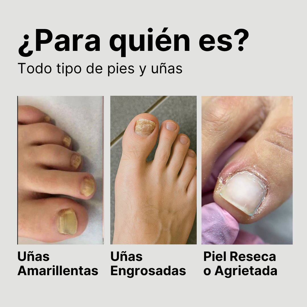 Aceite antihongos para uñas de pies