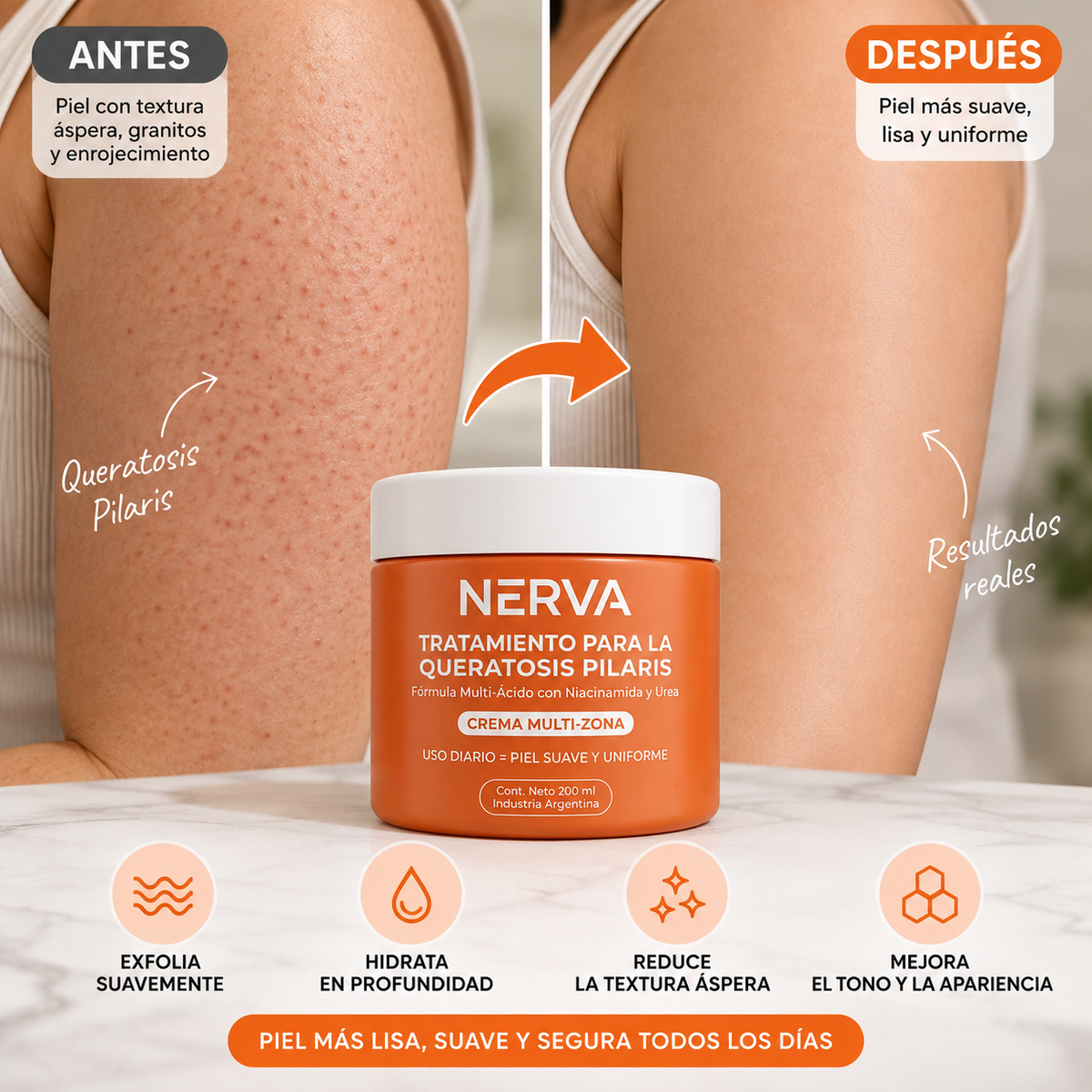 NERVA™ - Tratamiento para la Queratosis Pilaris