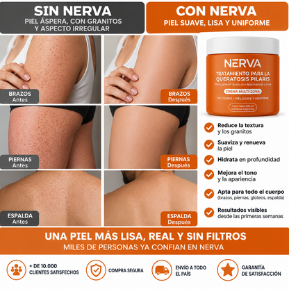 NERVA™ - Tratamiento para la Queratosis Pilaris